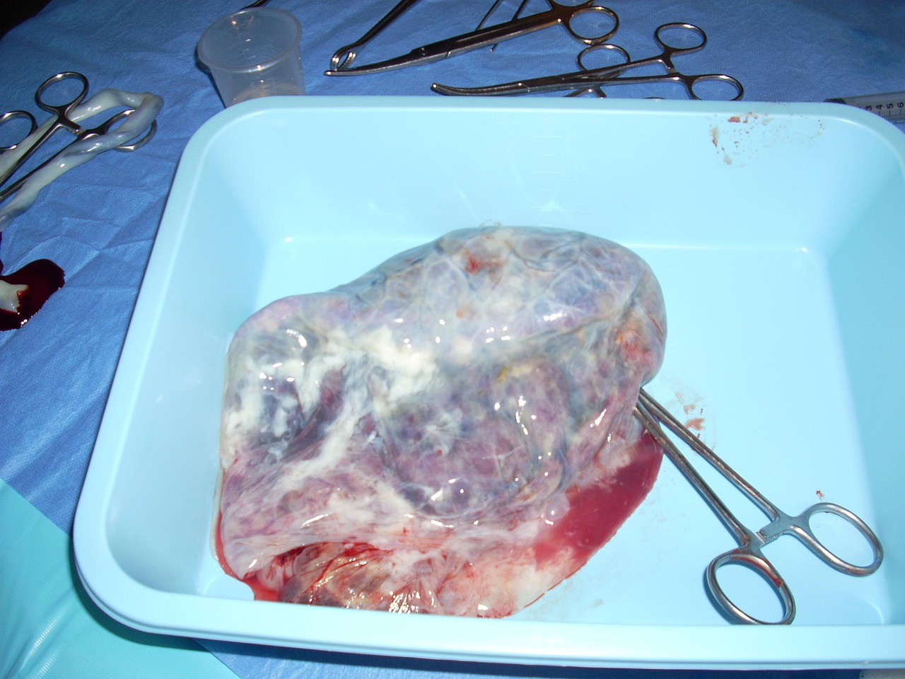 How to Choose a Bank for Umbilical Blood Cord Stem Cells?