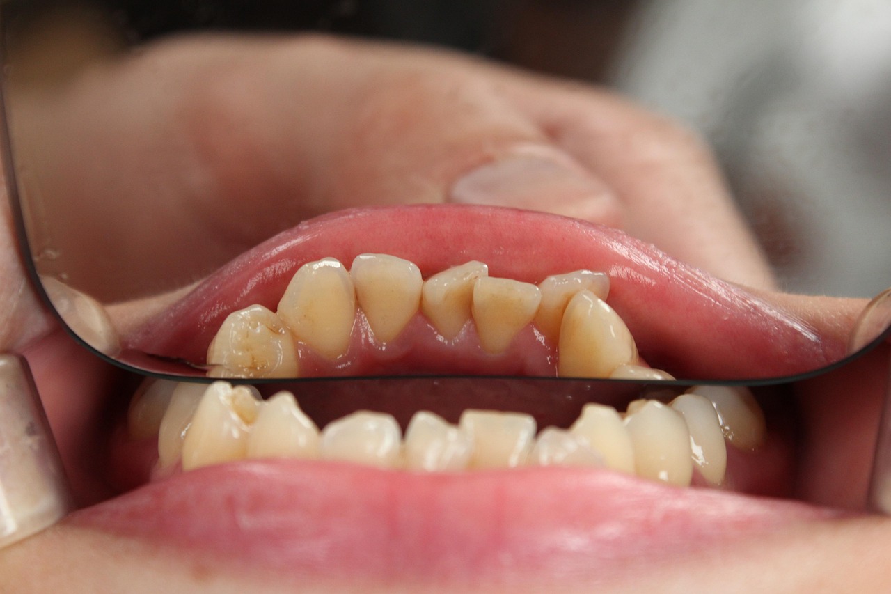 The Role of a Dentist in Handling Severe Tooth Sensitivity