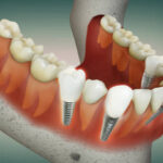 Dental implants